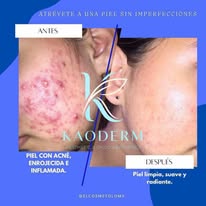 Retiro de verrugas párpados espalda rostro cuello axilas